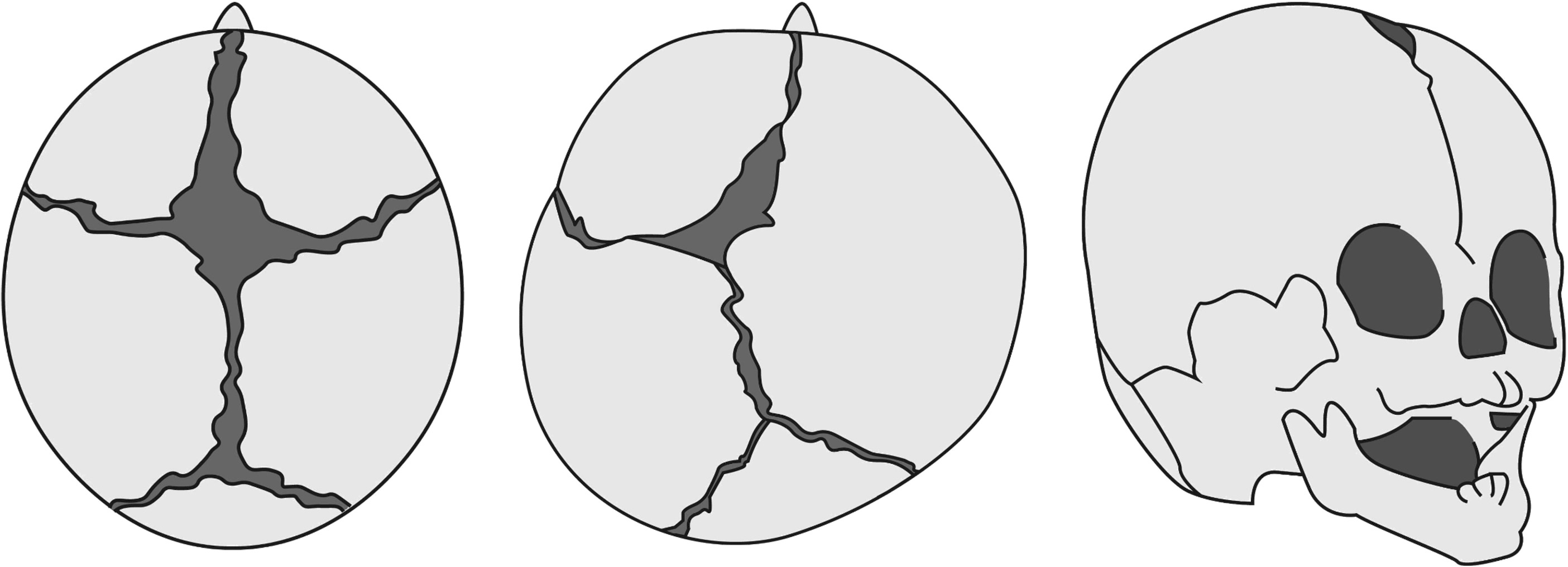 【医師解説】位置的頭蓋変形症と頭蓋骨縫合早期癒合症の見分け方とは？