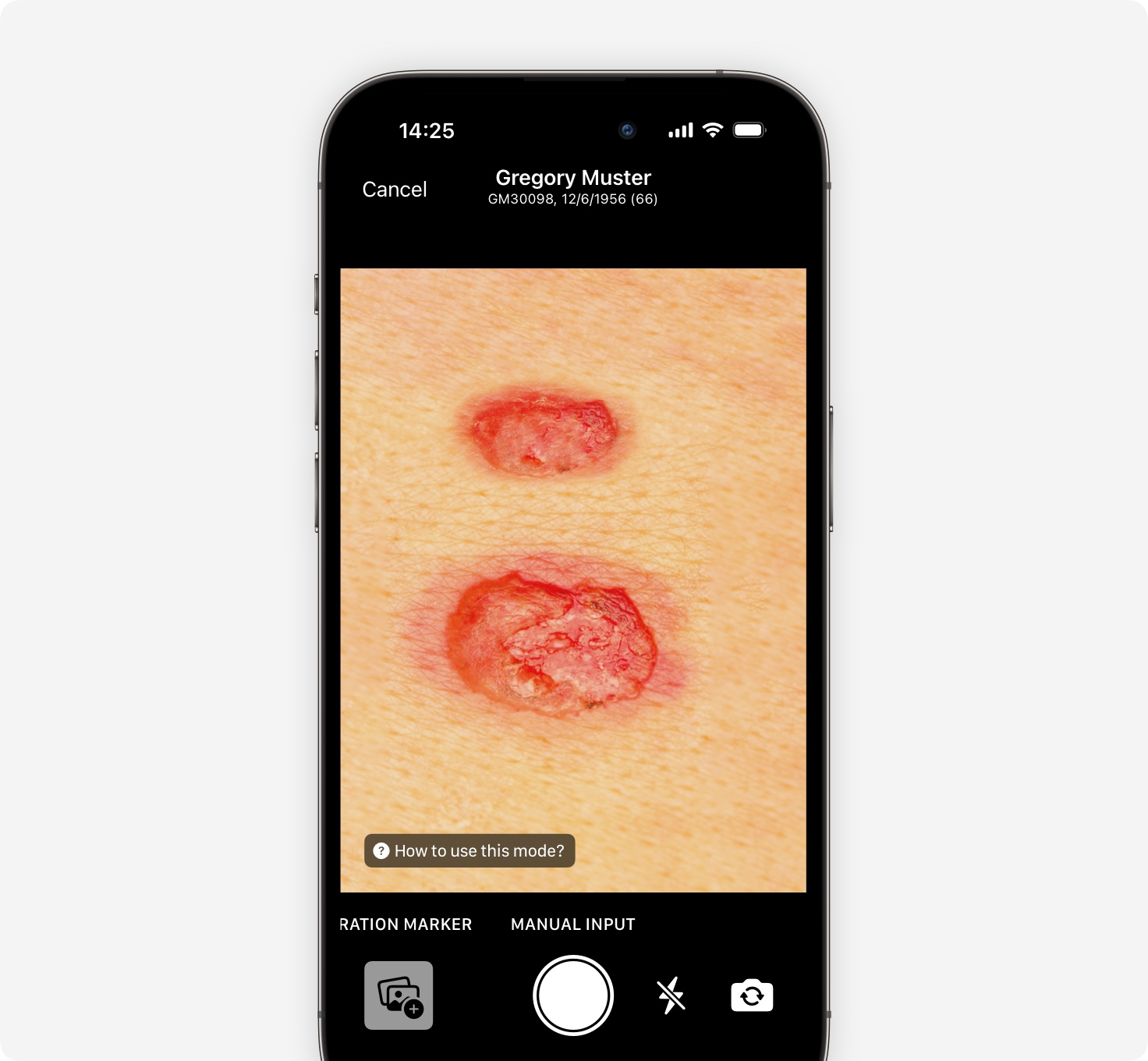 Wound measurement with imito - when to choose which measurement mode