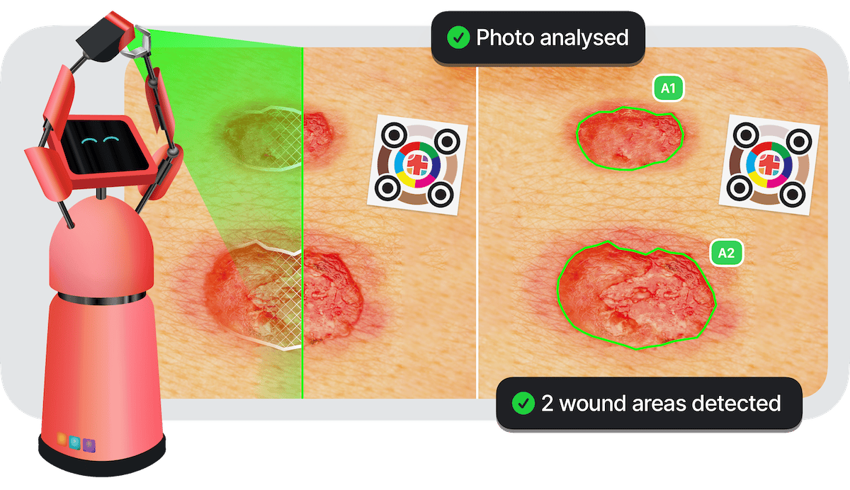 imito's automatic wound measurement