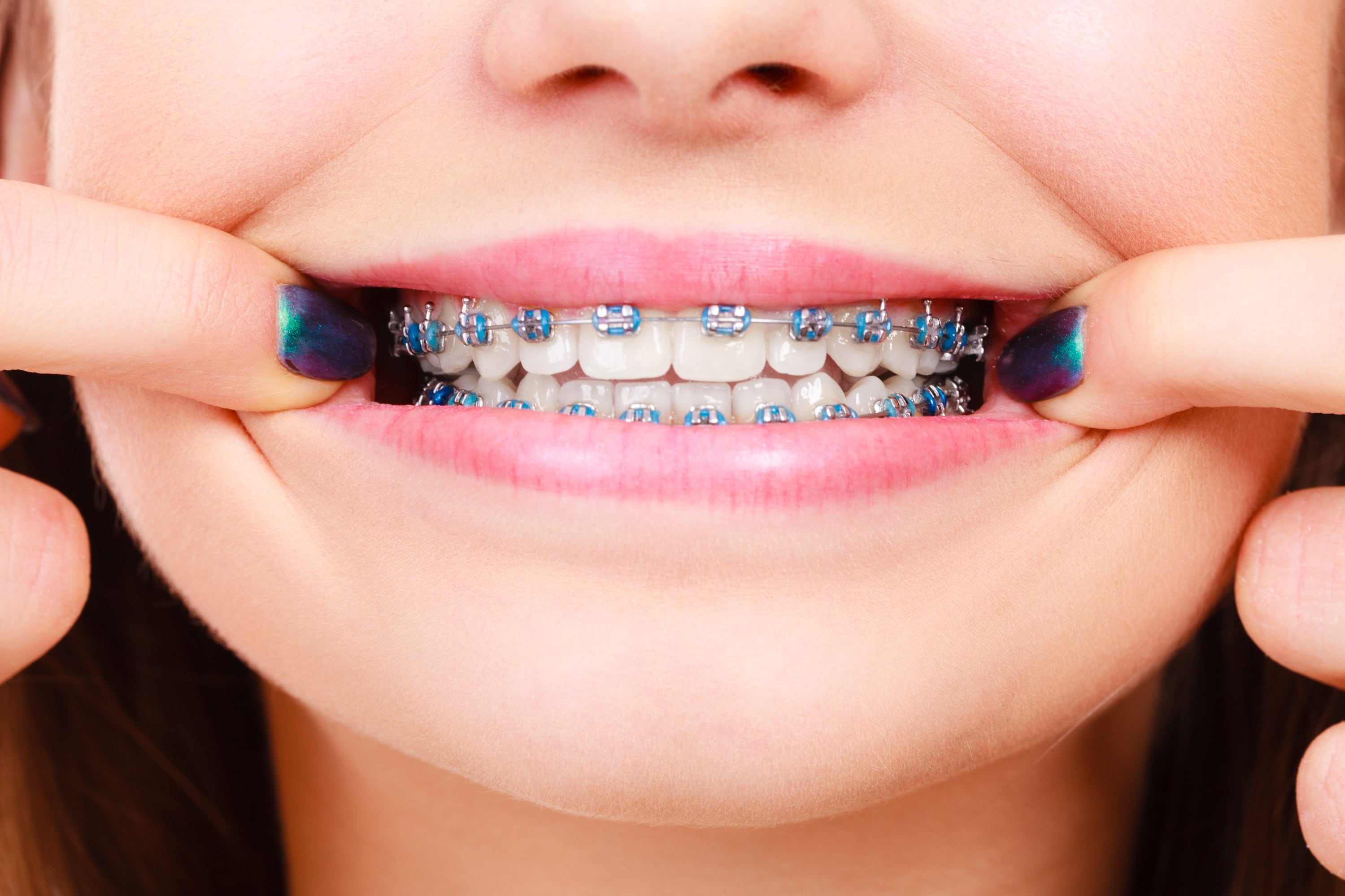 Close up of girl smiling with braces