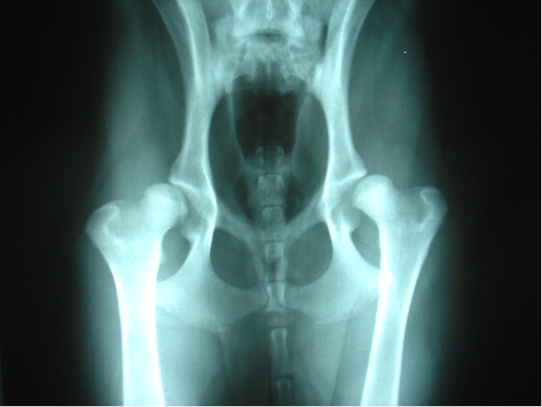 Bilateral Hip Dysplasia