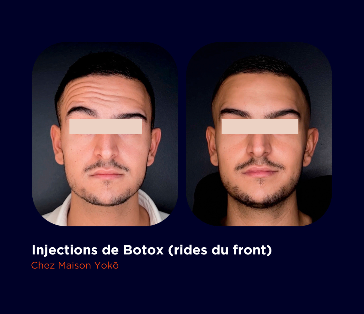 Avant/après injections de Botox au niveau du front par un expert chez Maison Yokō. 