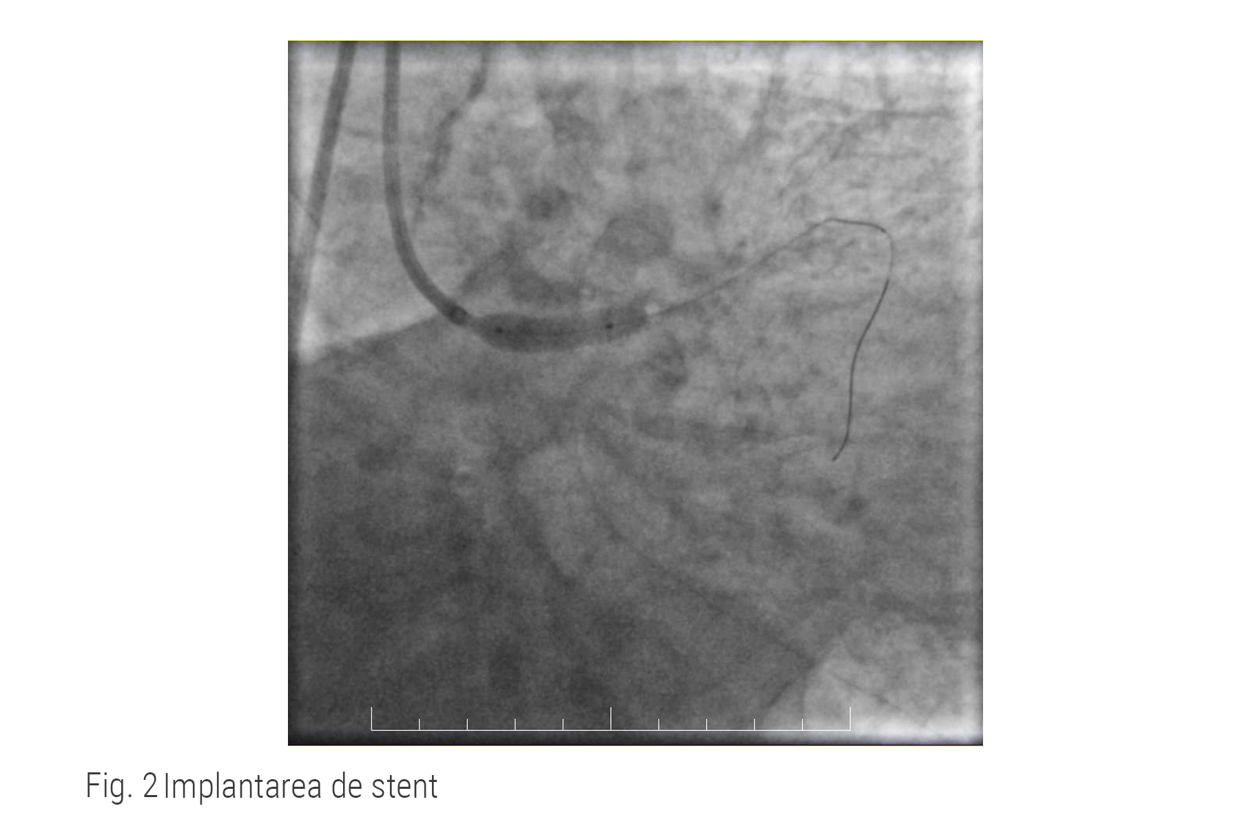 Imagine angiografica, implantarea de stent în inimă