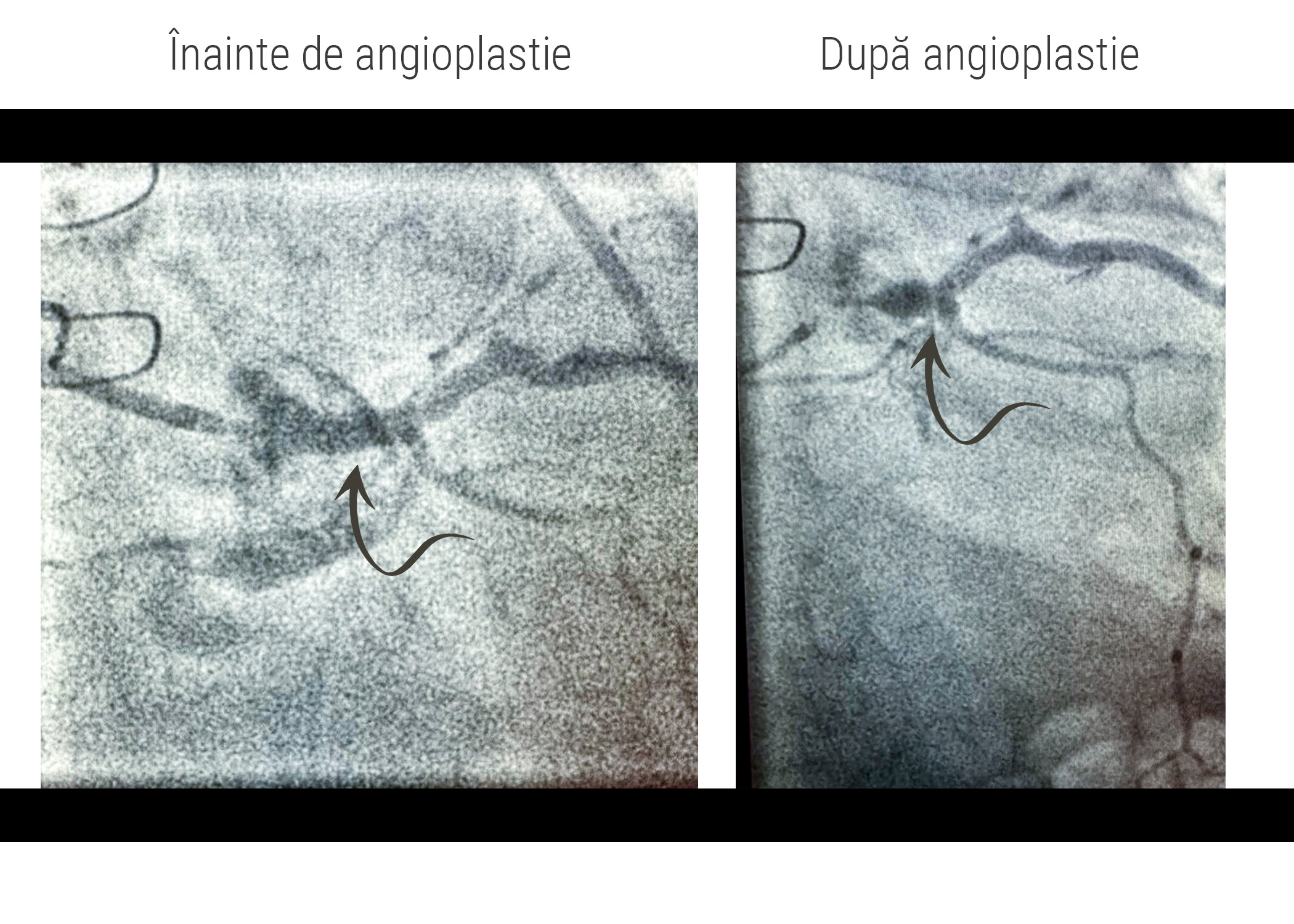 Imagine angiografică a unor stenoze coronariene