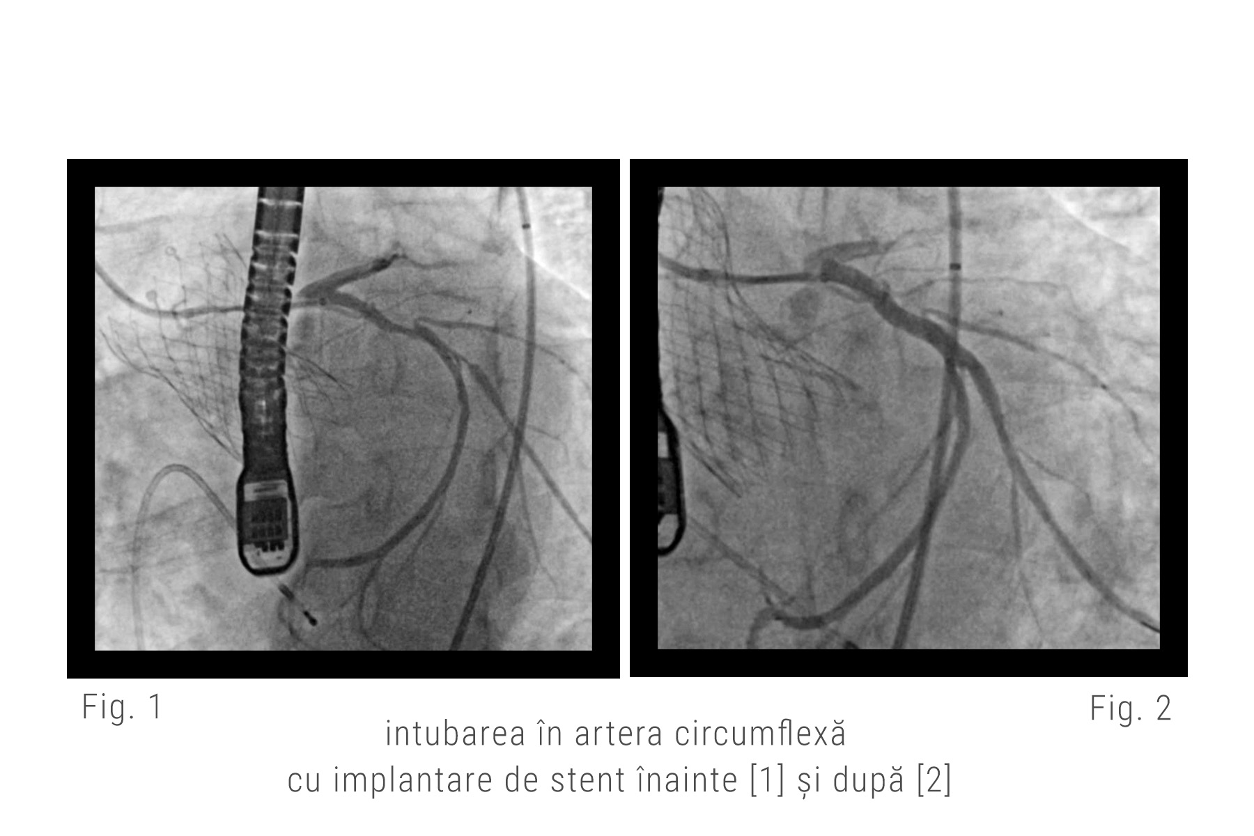 Imaginea angiografica a intubarii in artera circumflexa cu implantare de stent