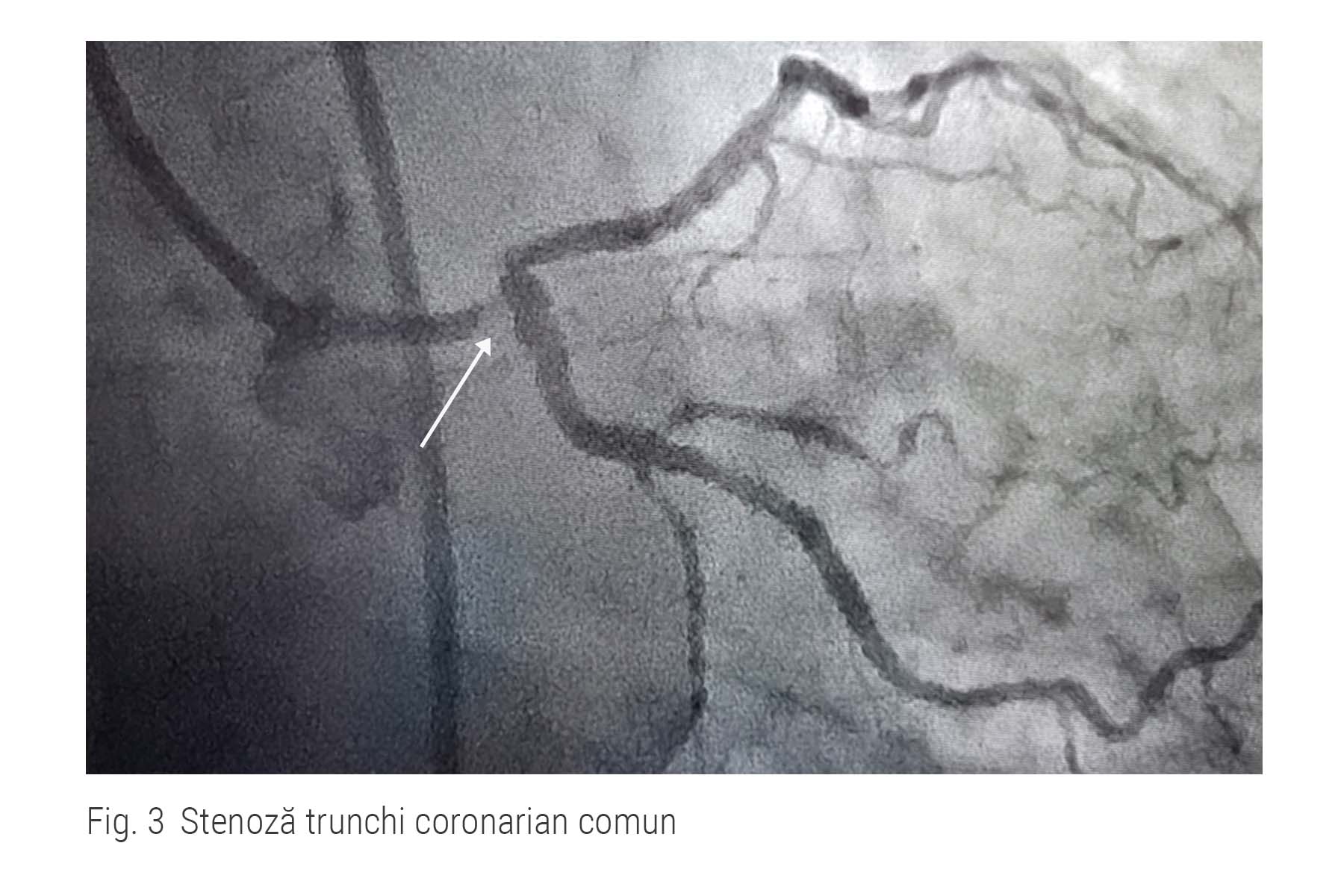 Stenoza de trunchi coronarian comun