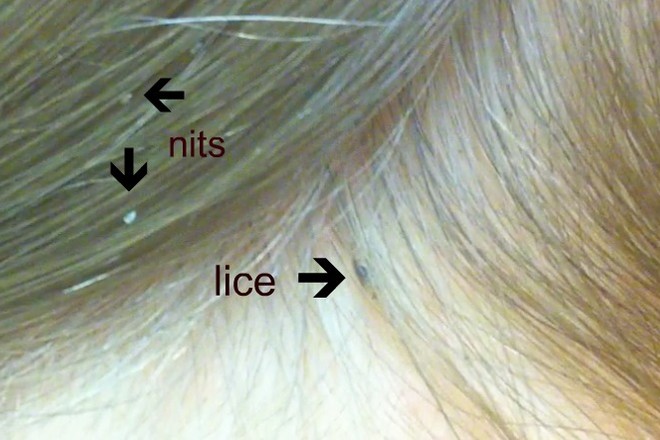 lice nits head child hair symptoms children infestation kill signs might parent guide