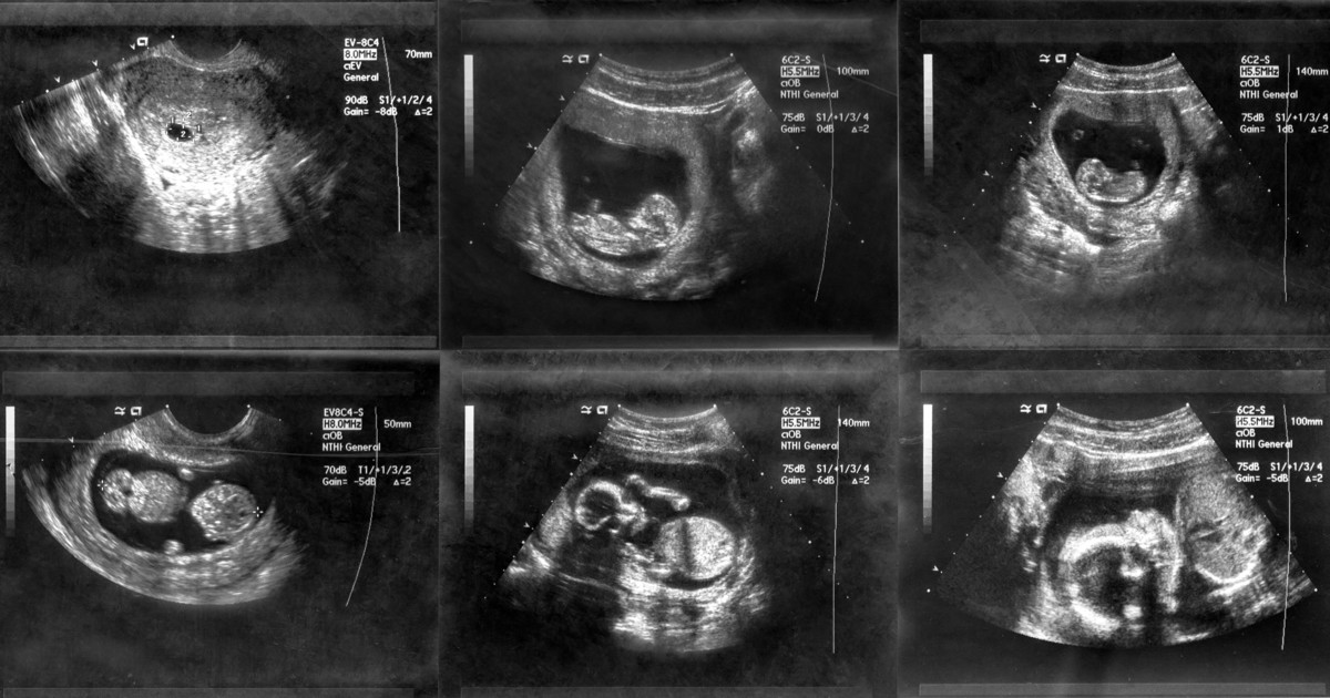 12 Weeks Pregnant Ultrasound Girl