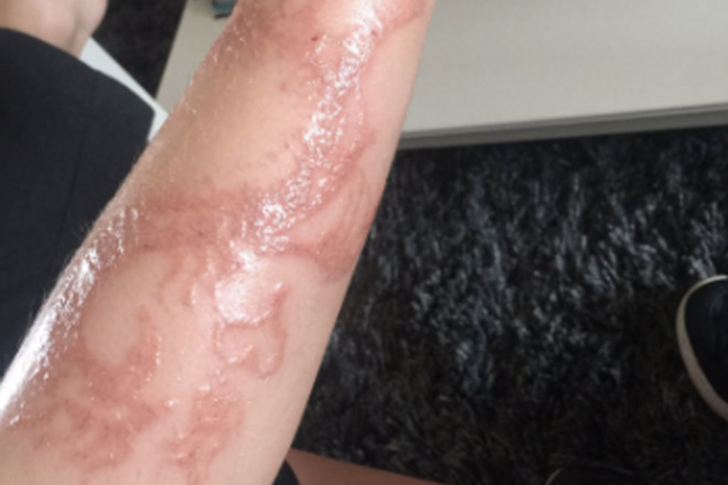 natasha hamilton warns of dangerous henna tattoo after son has natasha hamilton warns of dangerous henna tattoo after son has