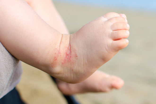 eczema-in-babies-and-children-netmums