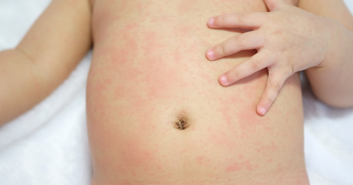 Heat Rash On Baby Back Pictures Heat Rash On Babies Causes