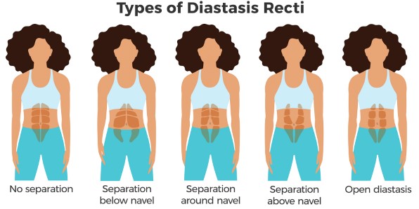 diastasis-recti